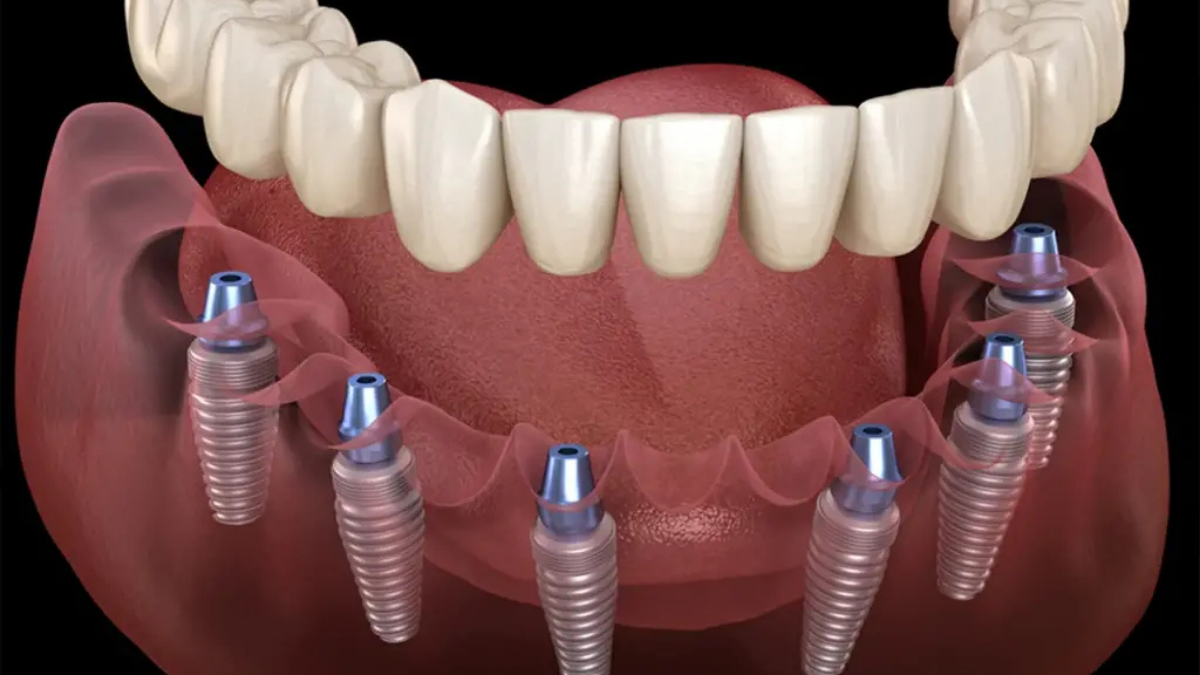 Apexcore İmplant: Türkiye’de Diş Hekimliği İçin Yeni Nesil Operasyonel Çözüm